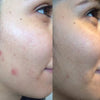 Soin esthétique vieillissement anti âge lifting mircroneedling acnée peeling masque blanchiment dentaire dent blanche tâche rides hyperpigmentation sécheresse peau rosacée cicatrices pores dilatés imperfections relâchement cutané poche yeux Tunis La Marsa