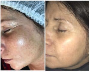 Soin esthétique vieillissement anti âge lifting mircroneedling acnée peeling masque blanchiment dentaire dent blanche tâche rides hyperpigmentation sécheresse peau rosacée cicatrices pores dilatés imperfections relâchement cutané poche yeux Tunis La Marsa