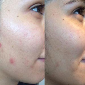 Soin esthétique vieillissement anti âge lifting mircroneedling acnée peeling masque blanchiment dentaire dent blanche tâche rides hyperpigmentation sécheresse peau rosacée cicatrices pores dilatés imperfections relâchement cutané poche yeux Tunis La Marsa
