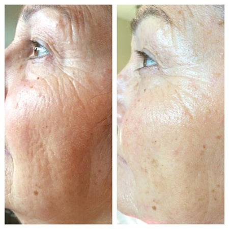 Soin esthétique vieillissement anti âge lifting mircroneedling acnée peeling masque blanchiment dentaire dent blanche tâche rides hyperpigmentation sécheresse peau rosacée cicatrices pores dilatés imperfections relâchement cutané poche yeux Tunis La Marsa